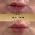 Lip Fillers Wilmslow with Anti-wrinkle injections
