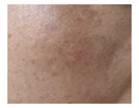 Melasma
