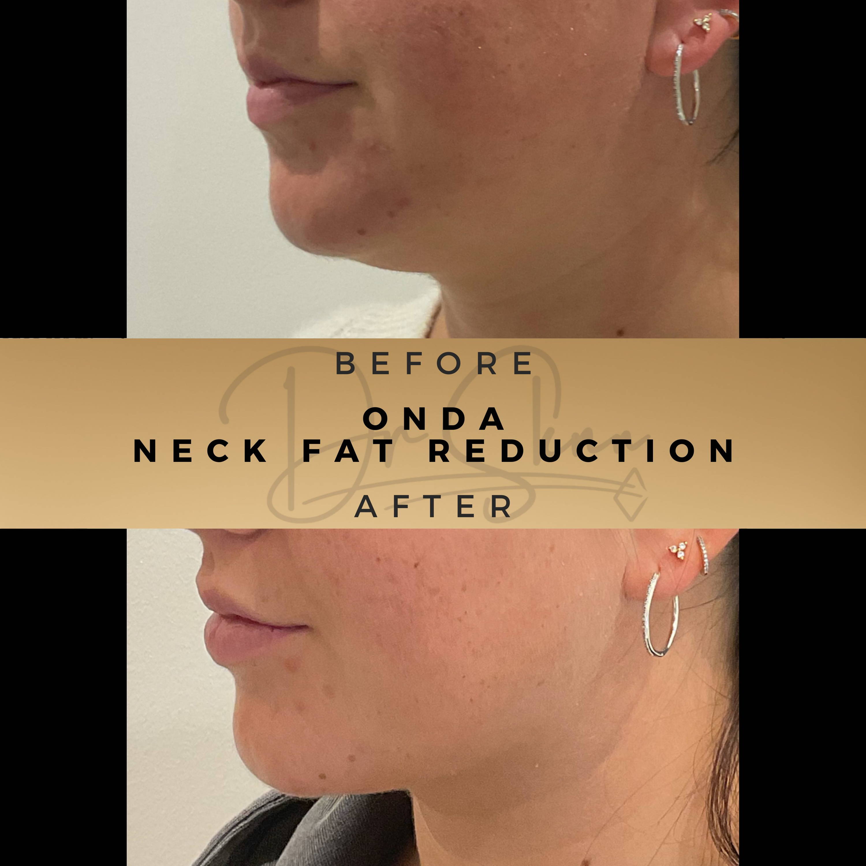 Neck Tightening Treatment Wilmslow Before & After Dr Sknn