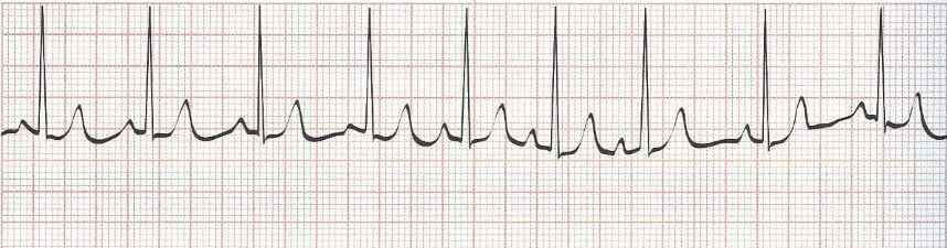 Sinus Arrhythmia with wandering atrial pacemaker