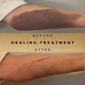 Wound Healing Treatment Wilmslow Dr Sknn Before & After Picture