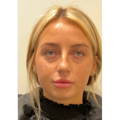 NON SURGICAL FACE & NECK LIFT BEFORE