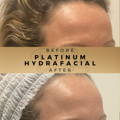 Platinum Hydrafacial Wilmslow Before and After Dr Sknn Cheshire