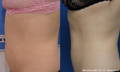 Side view of woman's abdomen before and after Morpheus8