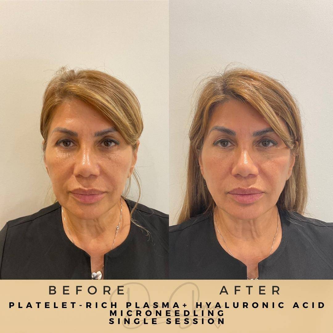 PRP Microneedling - Dr Sknn before and after