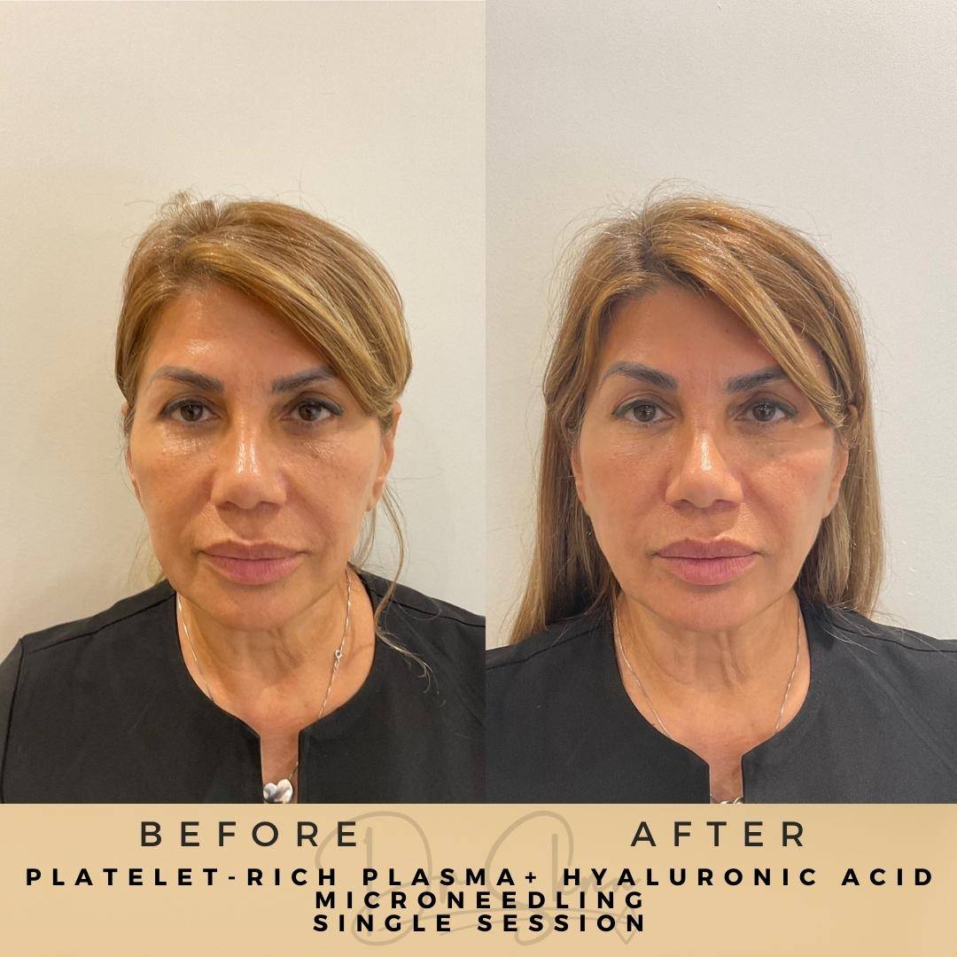 PRP Microneedling Wilmslow Before & After Dr Sknn