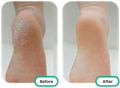 before and after of the heel after using the best tea tree oil singapore