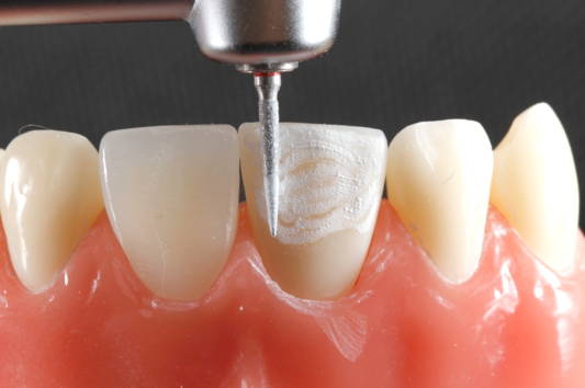 Dental bur touching tooth with white layer