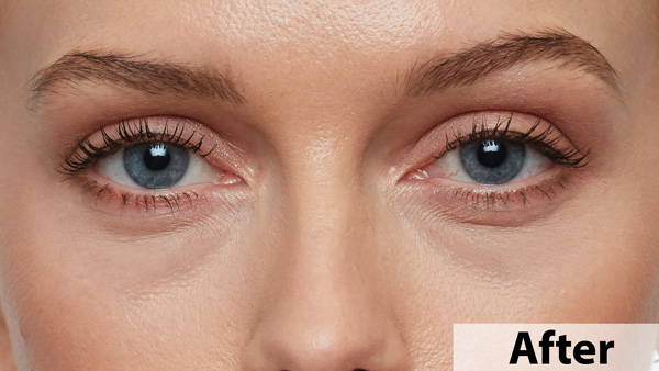 dark circle remover
