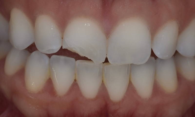 smile with fractured upper central incisor without reflection
