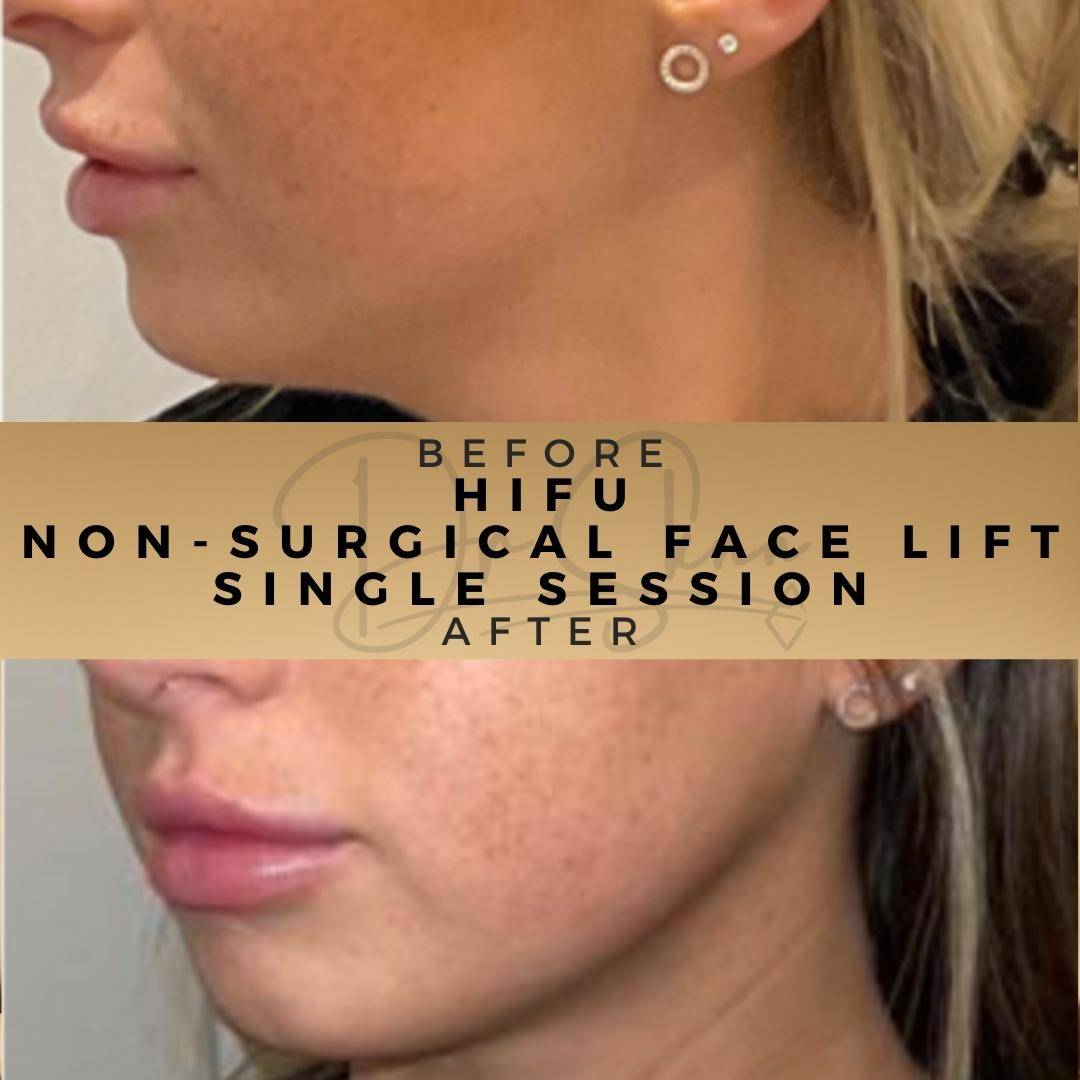 Non-surgical Facelift (HIFU) - Dr Sknn before and after
