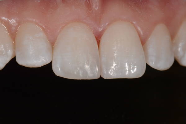 final result of fully restored tooth
