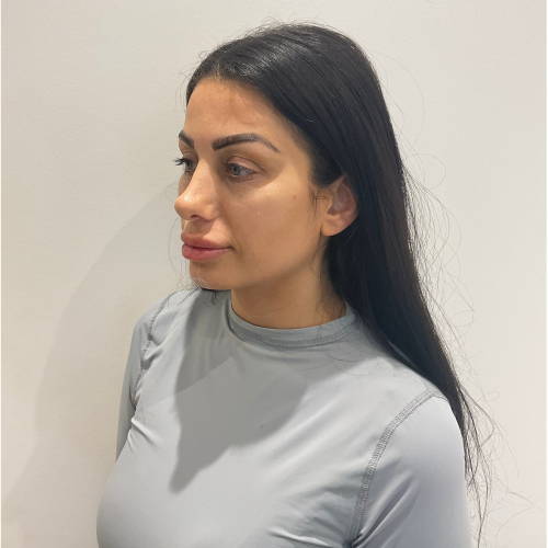 Dr Sknn Chin & Cheek Before