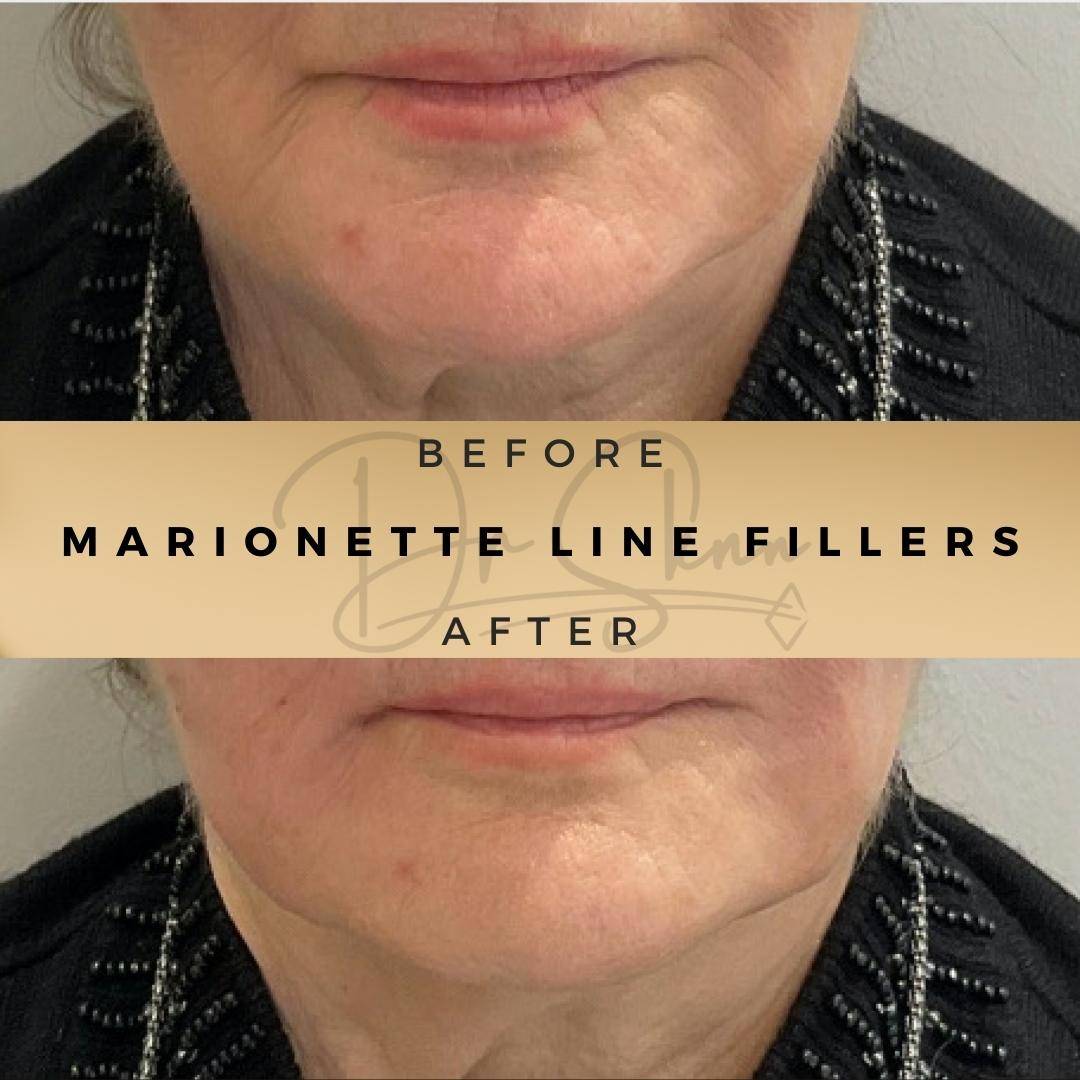 Marionette Line Fillers - Dr Sknn before and after
