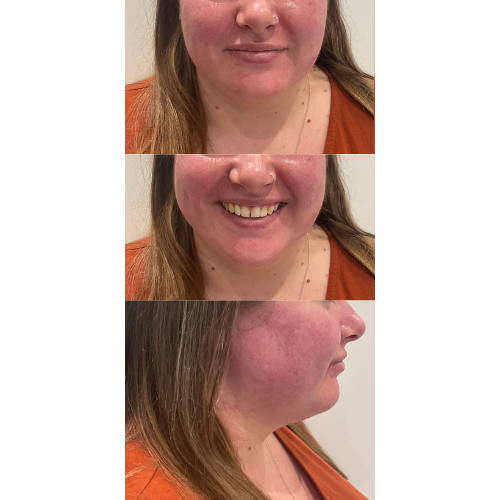 LIP FILLER WITH GUMMY SMILE CORRECTION BEFORE