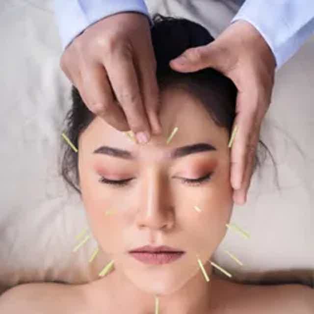 Facial acupuncture with chin, temples, and forehead needles applied to a calm woman.