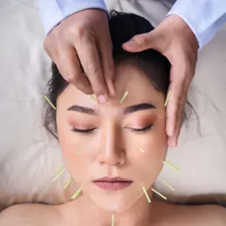 Facial acupuncture with chin, temples, and forehead needles applied to a calm woman.
