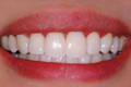 Anterior restoration: after the Bioclear Method