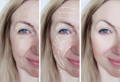 Simply You Med Spa Laser Skin Tightening