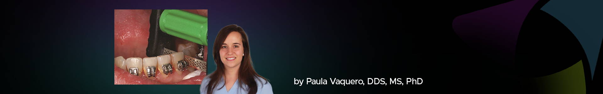 blog banner featuring Paula Vaquero and a dental clinical image