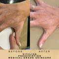 Vitiligo Treatment Before & After Pictures Dr Sknn Wilmslow Cheshire