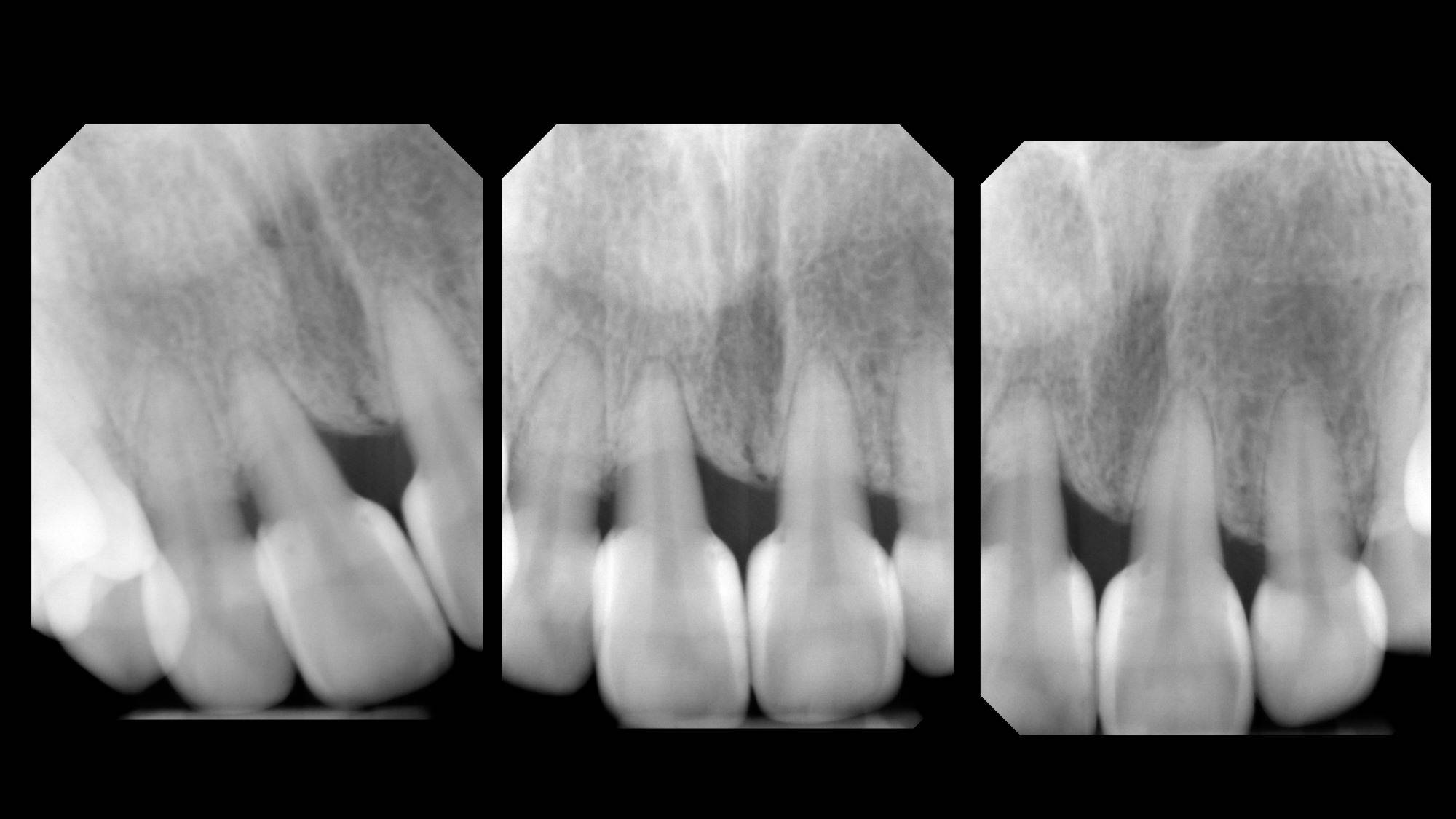 X-ray of post operative black triangle