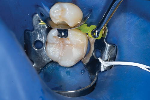 dental wedge being placed with tweezers