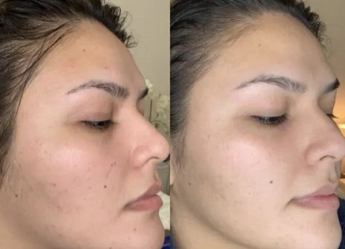 Valerie H. before and after