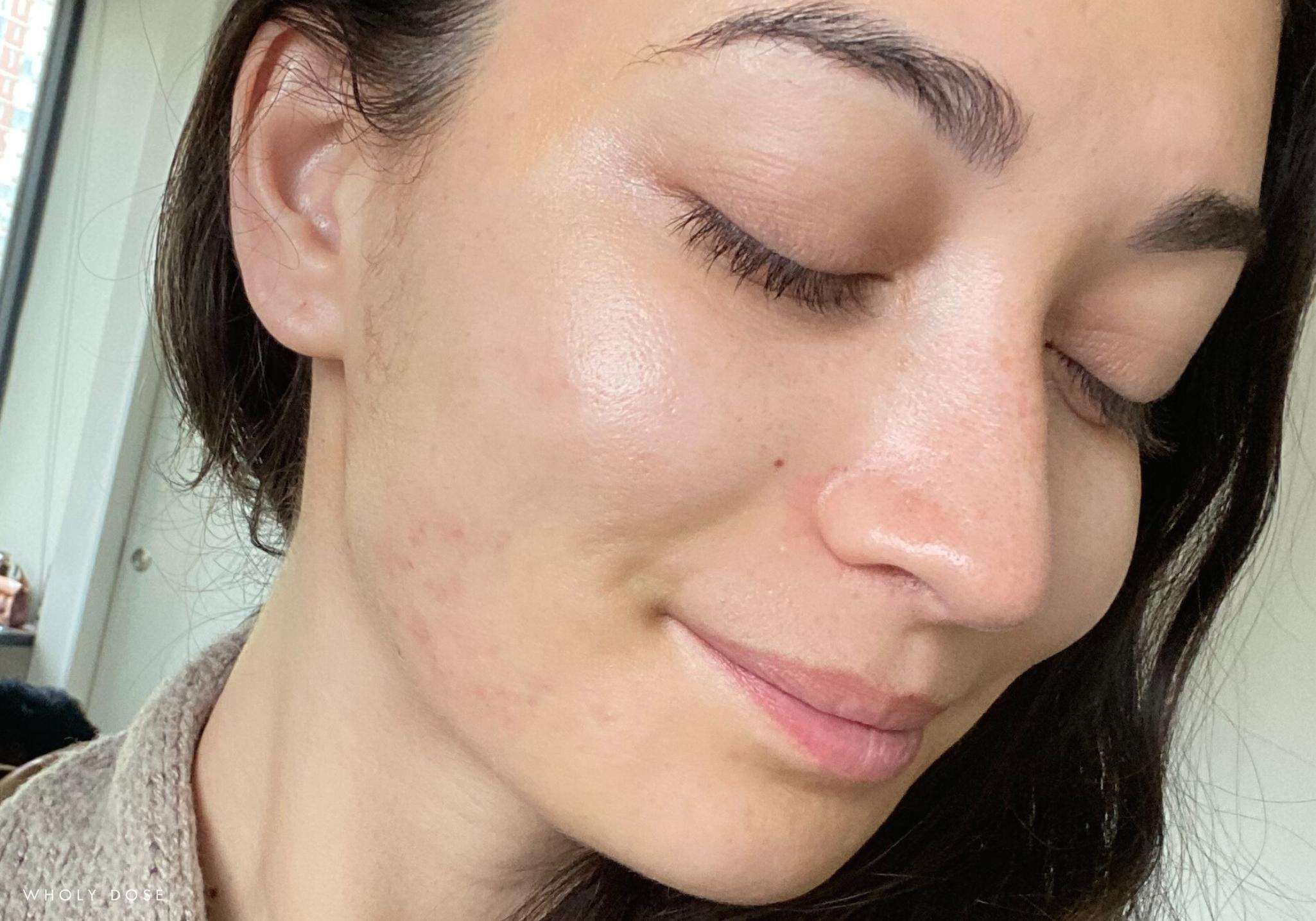marine-collagen-before-after-pictures-skin-face-acne