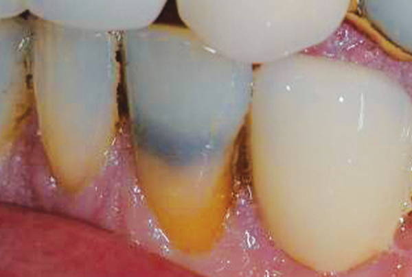 Opalescence Teeth: non-vital tooth before