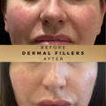 Cheek Fillers Wilmslow