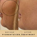 Before & After Pictures Dr Sknn Wilmslow Cheshire