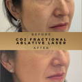 Skin Rejuvenation Co2 Fractional Laser Wilmslow Dr Sknn Before & After Picture