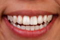Final result of an even smile