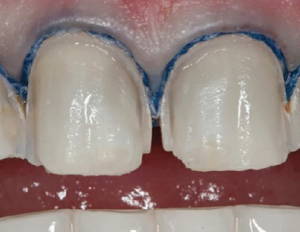 teeth with retraction cord in place