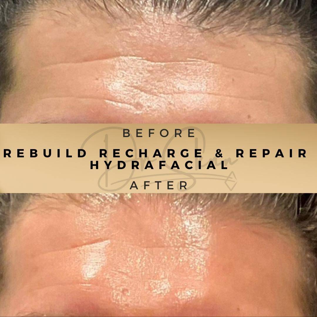 HydraFacial - Dr Sknn before and after
