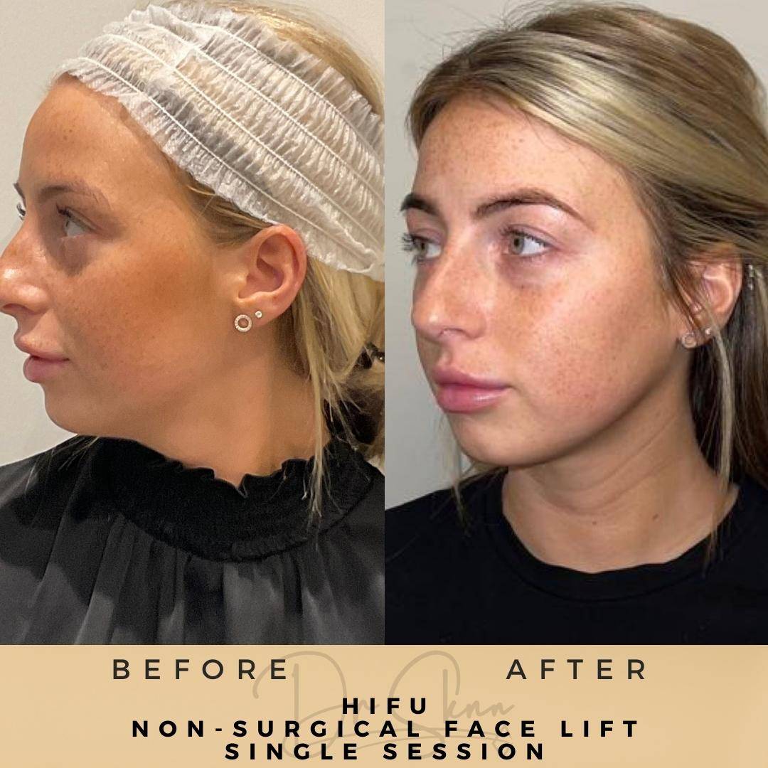 Non-surgical Facelift (HIFU) - Dr Sknn before and after