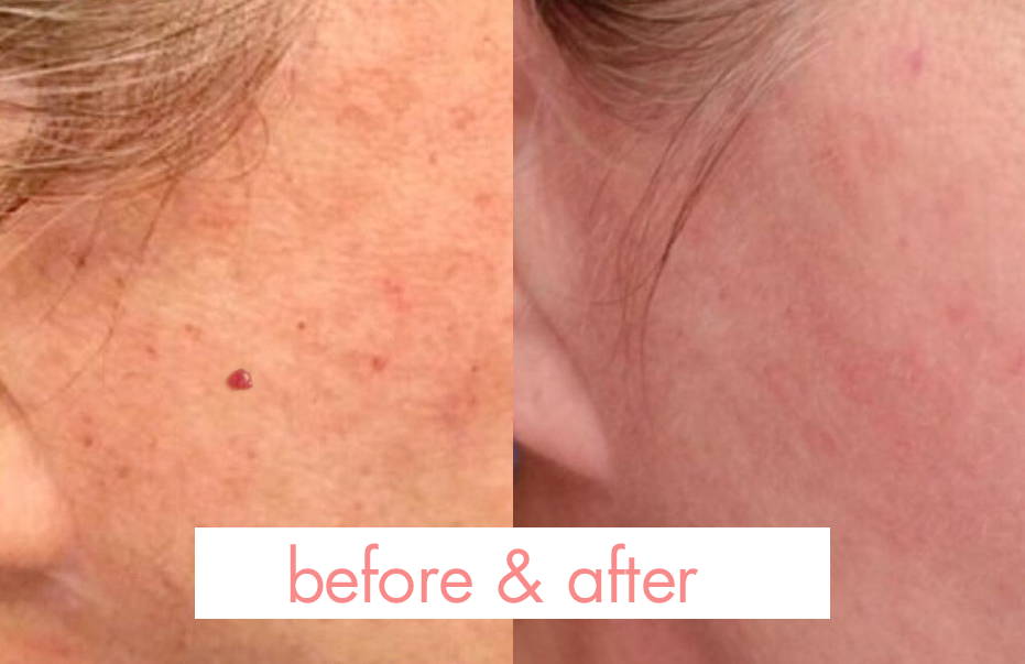 Skintify™ Remover Pen for Cherry Angiomas