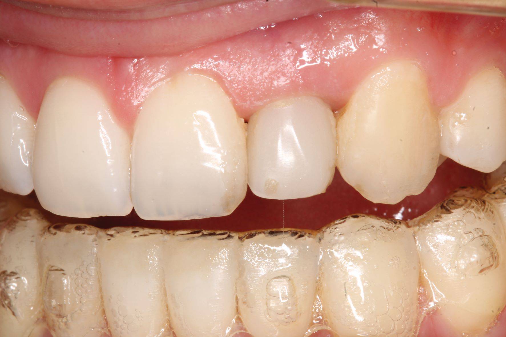 Mouth with focus on tooth with temporary restoration on implant