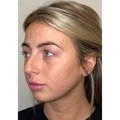 NON-SURGICAL FACE AND NECK LIFT AFTER