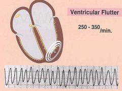 Ventricular flutter