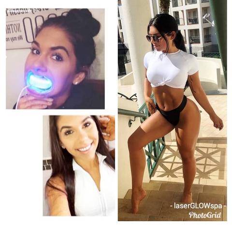 LaserGlow Spa Best LED Teeth Whitening Kit Alexa Fit