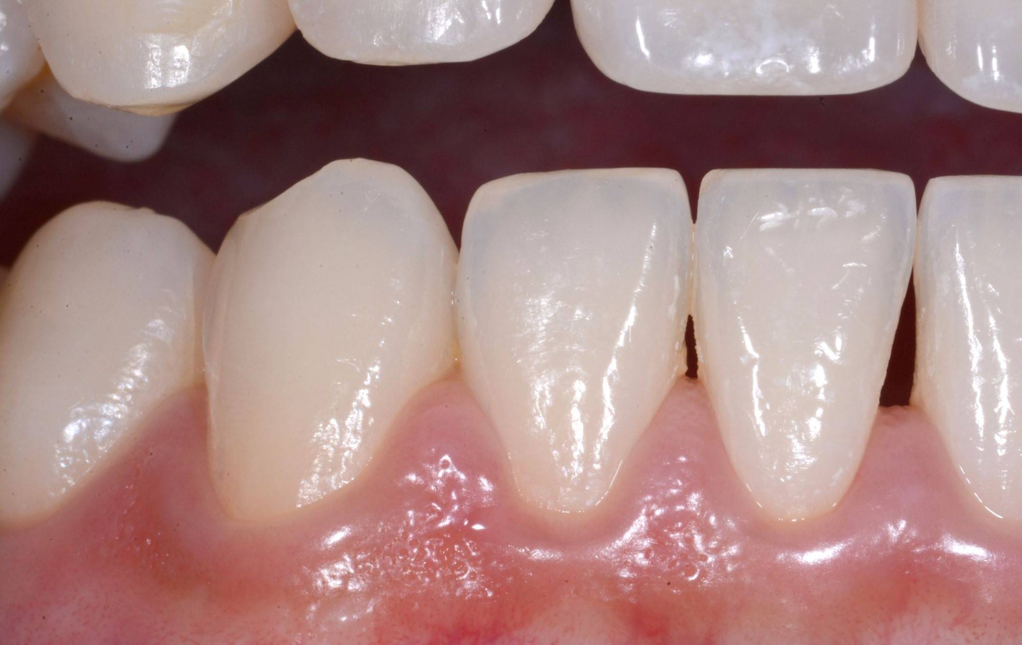 Close-up on smile showcasing small black triangle in lower central incisor and lower lateral incisor