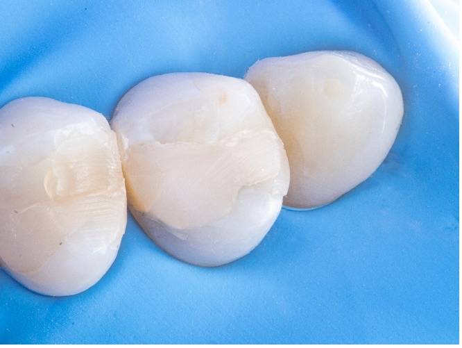 Image of tooth showing composite partially covering occlusal tooth surface