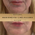 Marionette Line Filler Wilmslow Before & After Dr Sknn