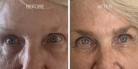Nulastin Results Increase Brow Thickness by 120%