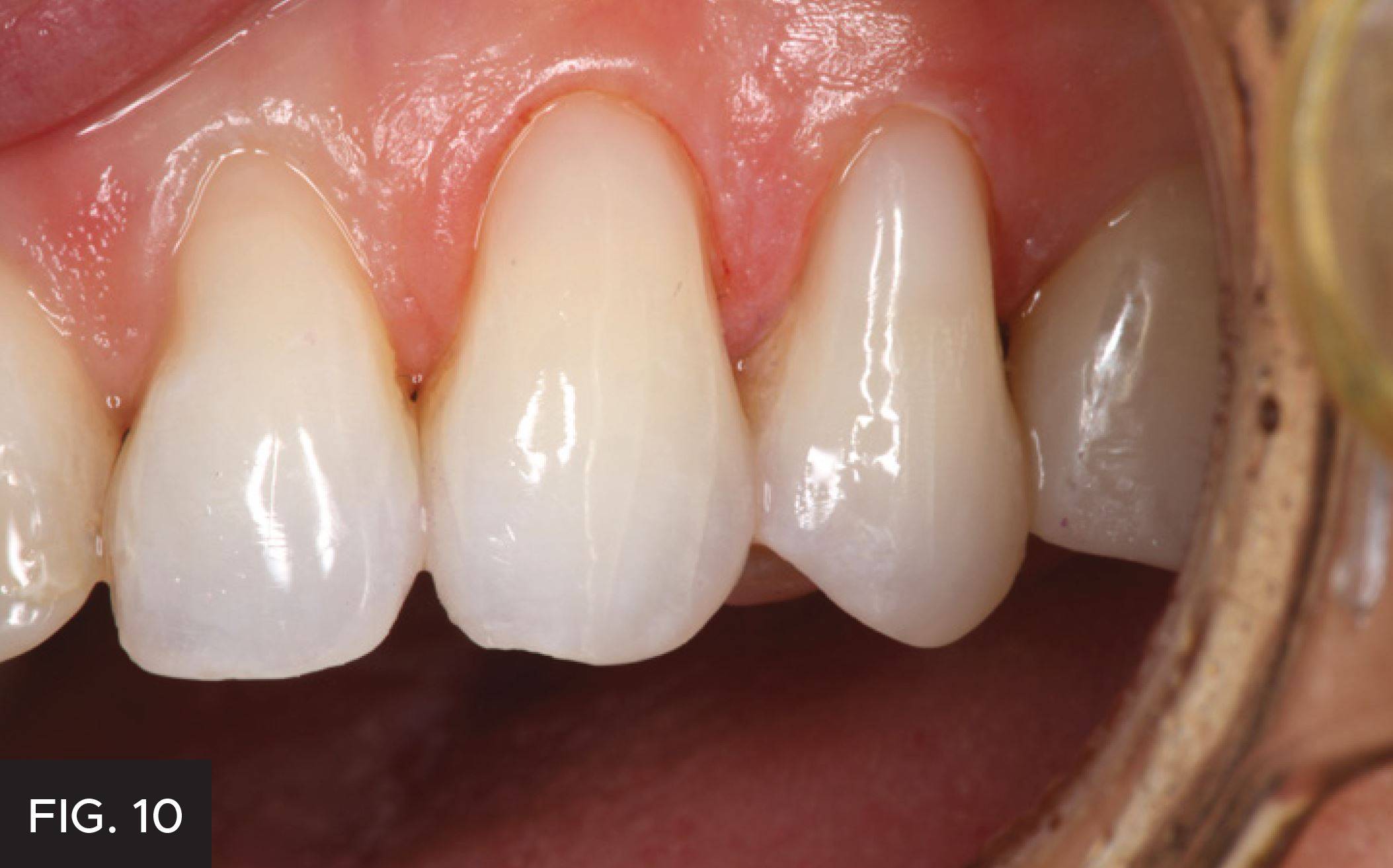 Simple, Beautiful and Predictable Class V Restorations: Figure 10