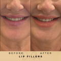 Lip Fillers Wilmslow with Anti-wrinkle injections