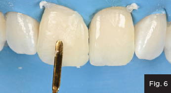a composite is adapted to the desired contour and tooth' width, blending it across the facial surface 