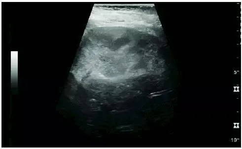Acute pyelonephritis: cortical echogenicity, ill-defined superior renal pole image scanned by EagleView portable ultrasound.